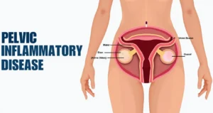 pelvic inflammatory disease
